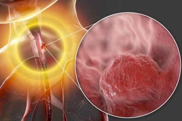 Câncer de esôfago: uso de preservativo ajuda a prevenir tumor