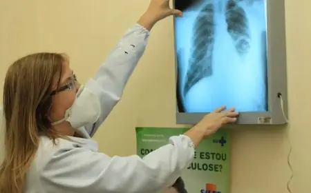 Baixo financiamento mundial ameaça combate à tuberculose