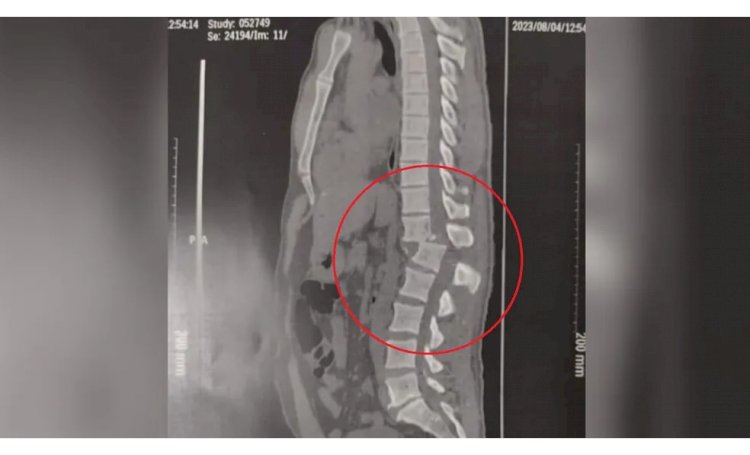 Aluno atingido por aparelho em academia consegue ficar sentado, mas permanece paraplégico após a cirurgia, diz médico